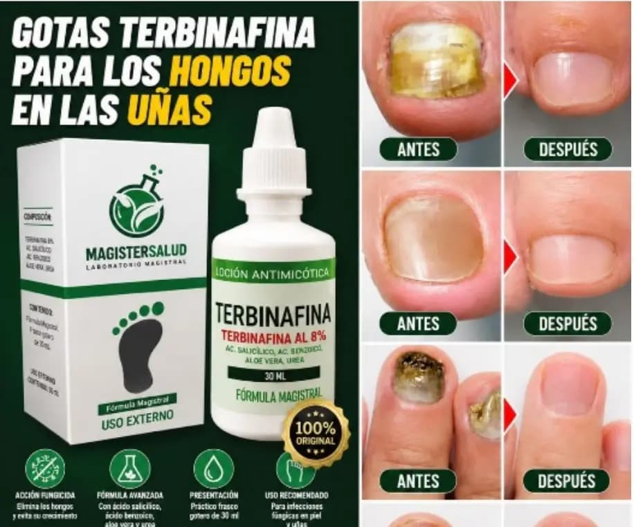 TERBINAFINA
